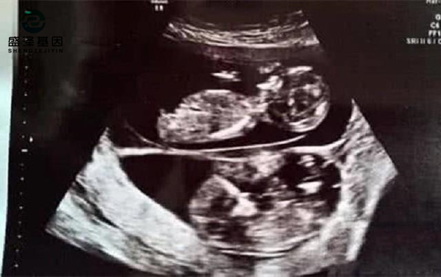 廣東男子做親子鑒定,竟發現自家雙胞胎有一個不是自己的?! 廣東男子做親子鑒定,竟發現自家雙胞胎有一個不是自己的?!