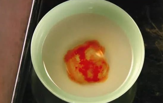 親子鑒定檢驗血型血痕，被鑒定人應了解自己或近親屬有無遺傳病史