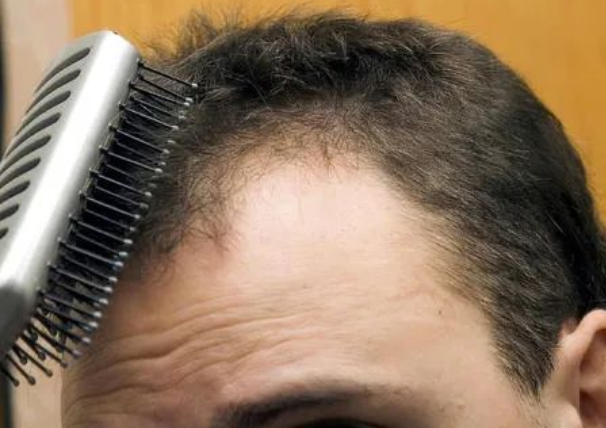 毛發可以做親子鑒定檢材嗎，怎么采集樣本才可以？